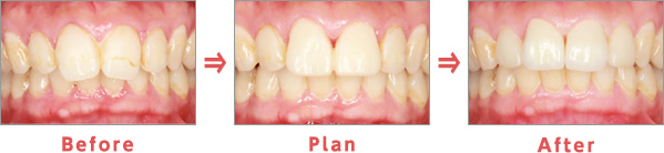 ワイヤー矯正の症例写真｜本多歯科
